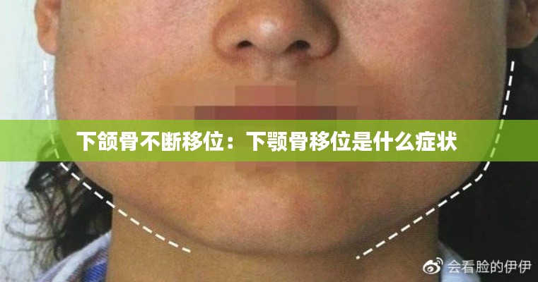 下颌骨不断移位：下颚骨移位是什么症状 