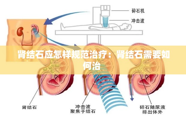 肾结石应怎样规范治疗：肾结石需要如何治 