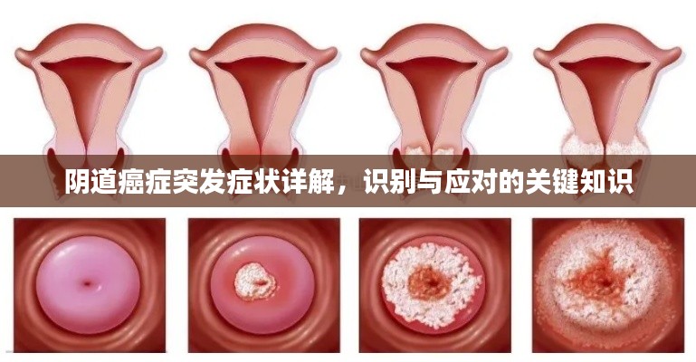 阴道癌症突发症状详解，识别与应对的关键知识