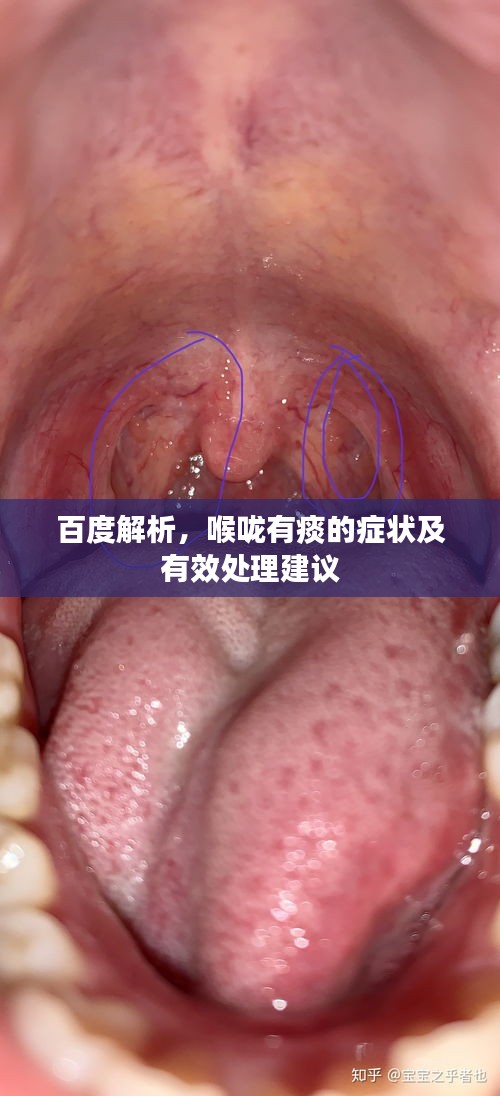 百度解析，喉咙有痰的症状及有效处理建议