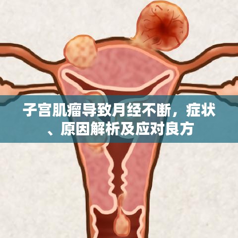 子宫肌瘤导致月经不断，症状、原因解析及应对良方