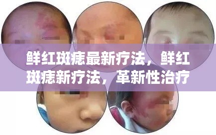 革新性鲜红斑痣治疗策略，引领未来的鲜红斑痣最新疗法