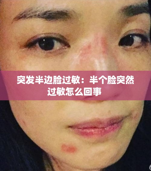 突发半边脸过敏：半个脸突然过敏怎么回事 