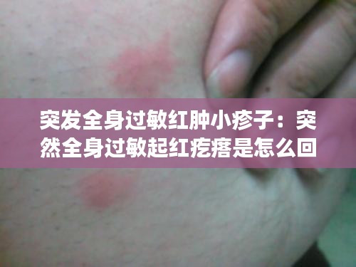 突发全身过敏红肿小疹子：突然全身过敏起红疙瘩是怎么回事痒 