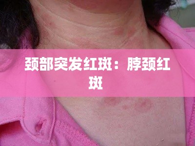 颈部突发红斑：脖颈红斑 