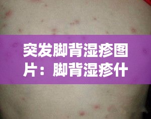 突发脚背湿疹图片：脚背湿疹什么症状 