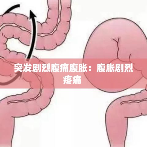 突发剧烈腹痛腹胀：腹胀剧烈疼痛 