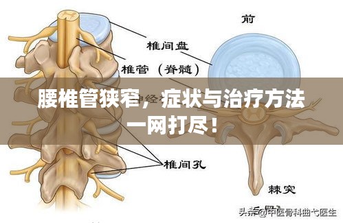腰椎管狭窄，症状与治疗方法一网打尽！